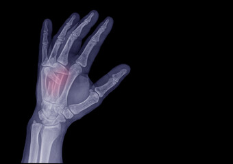 Obraz premium Hand x-rays to look at injuries as ordered by a doctor.