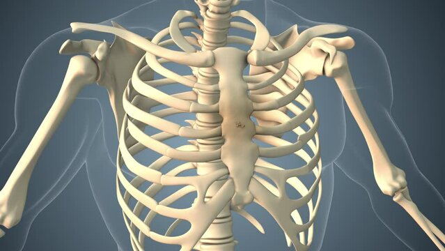 Cancer spreading along a breast bone