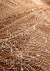 White snowflakes on the blonde's hair. Macro