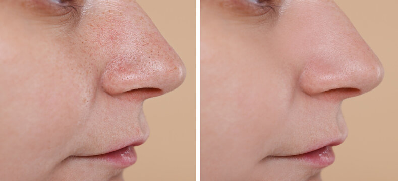 Blackhead treatment, before and after. Collage with photos of woman on beige background, closeup view
