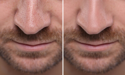 Blackhead treatment, before and after. Collage with photos of man, closeup view
