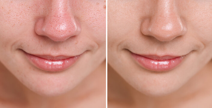 Blackhead treatment, before and after. Collage with photos of woman, closeup view