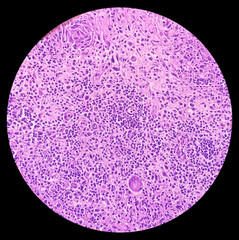 Cold abscess wall (biopsy). Chronic granulomatous inflammation (CGI) with Tuberculosis. CGI-TB. Section show multiple granulomas with Langhans' giant cells with chronic inflammatory cells.