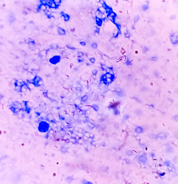 Mycobacterium tuberculosis in Sputum under light microscope. AFB stain.