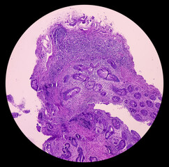 Rectal cancer. Rectum adenocarcinoma. IBD. IBS. Squamous cell carcinoma of the rectum. Grade 2 colorectal cancer, microscopic view.