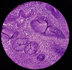 Rectal cancer. Rectum adenocarcinoma. IBD. IBS. Squamous cell carcinoma of the rectum. Grade 2 colorectal cancer, microscopic view.