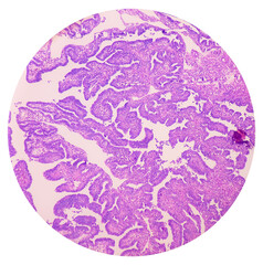 Ovarian cyst: Haemorrhagic cyst. Microscopic show ovarian cyst wall of fibrocollagenous tissue and...