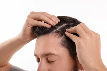 Naklejka premium Man with dandruff in his dark hair on white background, closeup