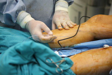 Process of varicose vein surgery in hospital, vein sealing, venous vascular surgery, phlebectomy surgery, surgical field marking, superficial veins problems, swollen skin, step by step - obrazy, fototapety, plakaty