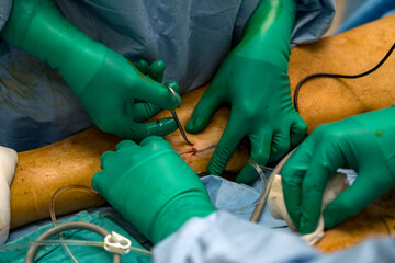 Process of varicose vein surgery in hospital, vein sealing, venous vascular surgery, phlebectomy...