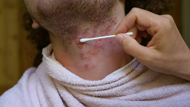 Footage with a close-up image of the face of a young Caucasian man suffering from seborrheic dermatitis. The condition of the skin and flaking rashes is checked with a cotton swab.