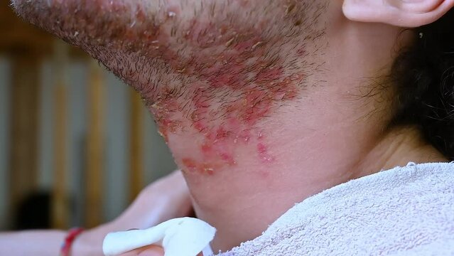 Slow motion footage with a portrait of the face of a young Caucasian man suffering from seborrheic dermatitis: a cotton pad is rubbed with micellar water to clean the skin. Skin and body care.