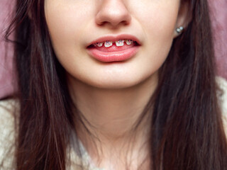 Teenager girl with pink color braces. Dentist procedure to straighten up teeth for better...
