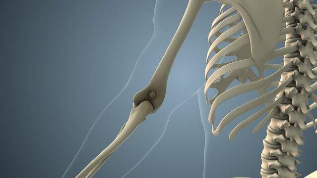 Cancer spreading along a elbow bone