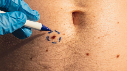 Preparing procedure for medical skin surgery. Unrecognizable Doctor in medical gloves paint lines around male birthmarks. Laser skin tags removal. Prevention of melanoma and nevus exam - obrazy, fototapety, plakaty