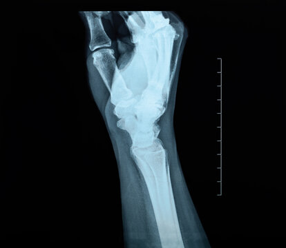 Lunate dislocation X-ray of the side of a woman`s hand and wrist uncommon traumatic wrist injury