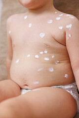 Toddler boy having chickenpox