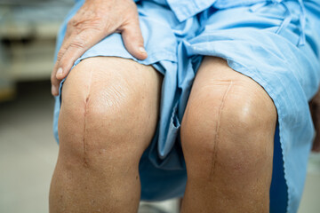 Asian elderly woman patient show her scars surgical total knee joint replacement Suture wound surgery arthroplasty on bed in hospital.
