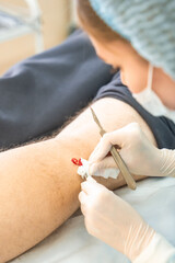 Dermatologist surgeon doctor removes skin diseases with scalpel and tweezers, close up view of...