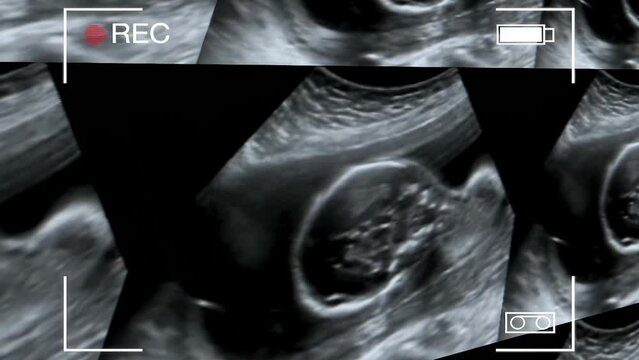 Collage of medical images of ultrasound during scan showing of pregnant women