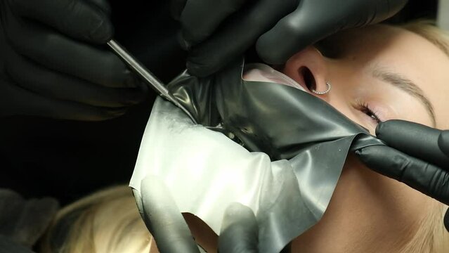Installing a rubber dam for a girl patient. Veneer installation process.