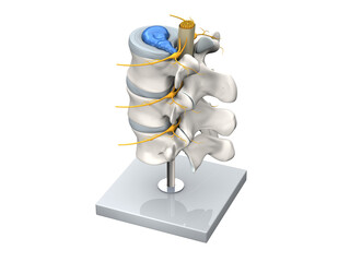 Model of a herniated disc of the lumbar spine. 3D Illustration