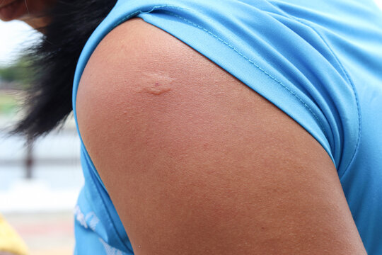 Skin allergy, allergic.hornet stings arm stung by a wasp worker. Yellow hornet stings arm.