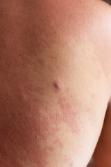 Human skin, presenting an allergic reaction, allergic rash. - obrazy, fototapety, plakaty