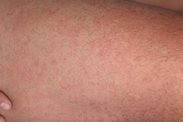 vesicular rash reaction from drug allergy