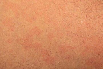 vesicular rash reaction from drug allergy.