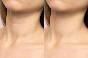 Crease and wrinkles on a woman’s neck before and after the rejuvenation procedure. Age-related...