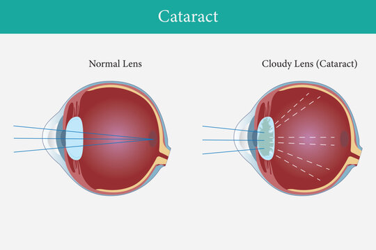 illustration of cataract in human eyes. eye vision disorder. vector illustration. eps 10