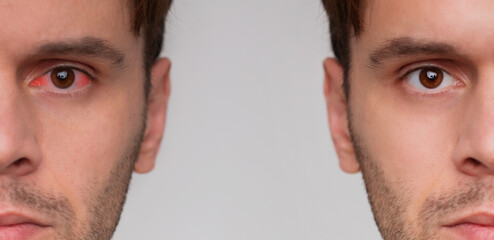 Close up portrait of man with red eye before and after treatment or eye drop. Tired eyes and...