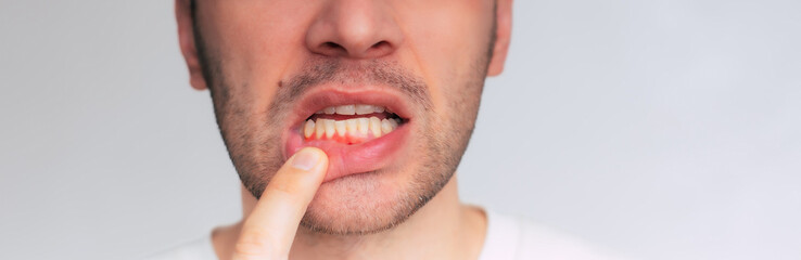 Close up image of gum inflammation. Cropped shot of a young man showing red bleeding gums isolated on a gray background. Dentistry, dental care.