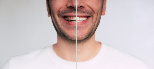 Dental health concept. Smile, mouth and teeth whitening. Closeup portrait face of happy man with...