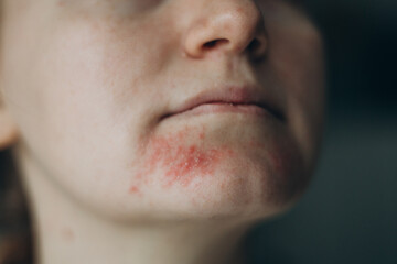 Perioral dermatitis on woman face. Closeup dermatitis on skin, ill allergic rash eczema skin of patient, atopic dermatitis symptom skin detail texture. The concept dermatology