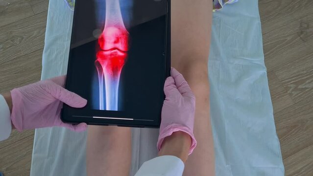 Traumatologist examines x-ray of little girl leg and inflammation of knee. Knee pain in a child