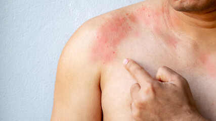 Fototapeta premium man poiting with itchy skin on the body on the chest or shoulde, itching due to rash, fungus, allergy, dermatological disease, dry skin. Healthcare and medical concept.