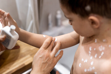 Woman applying cream onto skin of child ill with chickenpox, closeup