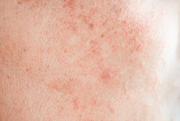 More red rashes appear on women's faces due to cosmetic allergies, dust allergies, allergies, dry...