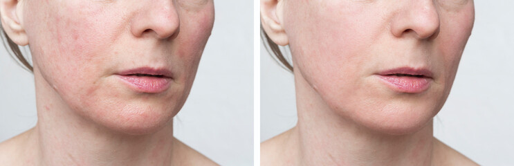 Problematic facial skin and after treatment. Care and proper nutrition for healthy skin.