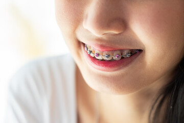 Young female beautiful smile with braces. Close up beautifying teeth. Oral hygiene, cleanliness....