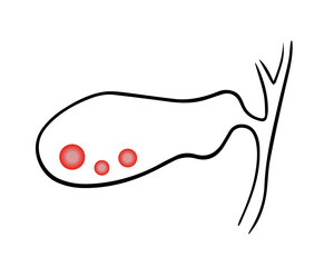 Vector isolated illustration of gall bladder.Gallstones.