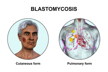 Clinical forms of blastomycosis, 3D illustration