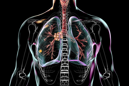 Primary lung tuberculosis with the Ranke complex, 3D illustration