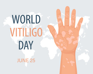 Hands with dermatological disease vitiligo. Medicine concept. World vitiligo day, awareness banner. Banner, poster, vector