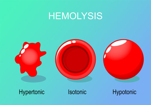 Hemolysis of Red blood cells.