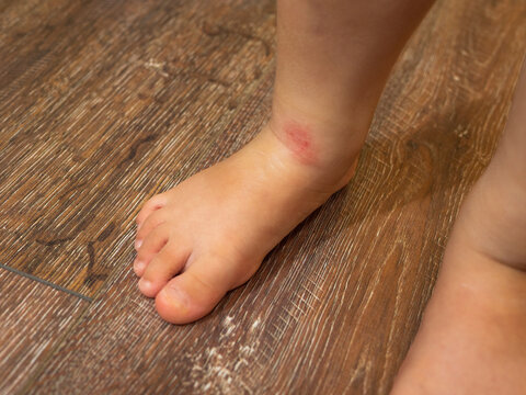 Legs of little child with red rash, closeup. Concept of babies allergies. Shot at home.