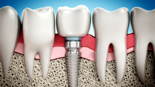 3D rendering of tooth implant showing jaw gum and bone layers. 3D illustration