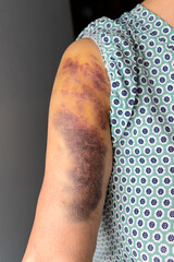 Haematoma on the arm of an elderly woman.